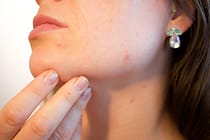 DISCOVER HOW TO CURE ACNE | keep your skin pimples free with a few simple steps