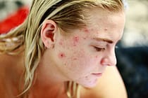 DISCOVER HOW TO CURE ACNE | manage acne problems with these tips and tricks