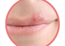 DISCOVER HOW TO CURE ACNE | cold sore vs pimple how to prevent treat and tell the difference between them