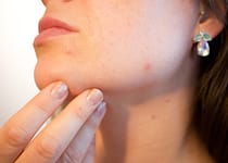 DISCOVER HOW TO CURE ACNE | keep your skin free of zits with these easy tips