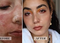 DISCOVER HOW TO CURE ACNE | i tried fractional co2 laser treatment and im amazed by the results see photos