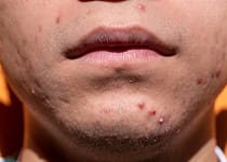 DISCOVER HOW TO CURE ACNE | stay blemish free with these helpful tips