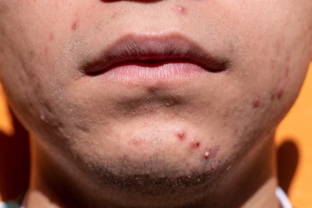 DISCOVER HOW TO CURE ACNE | eliminate problem skin from your life with these tips